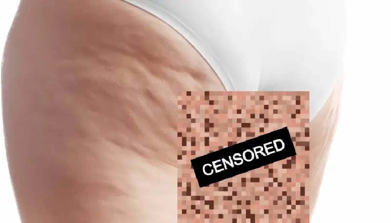 Zo Dát is Waarom Vrouwen Meer Cellulite Hebben dan Mannen