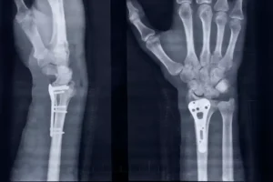 Bone-02