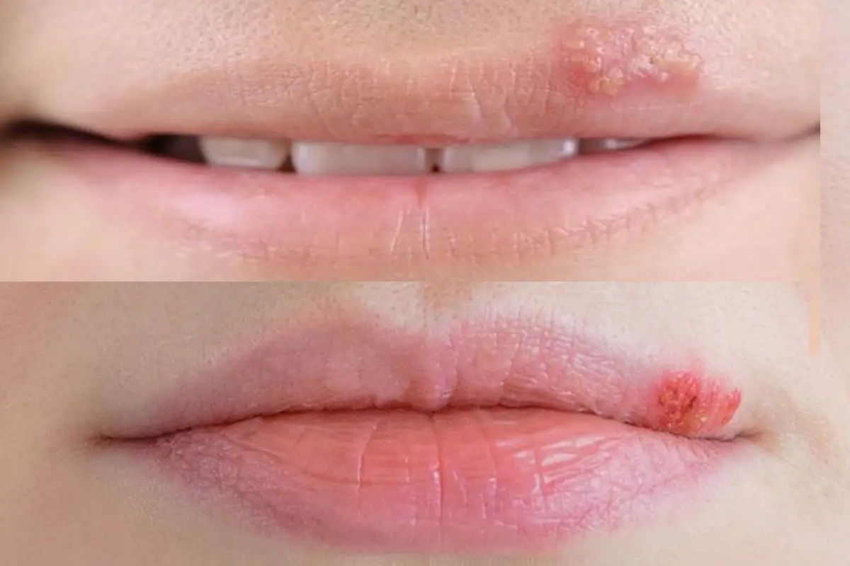 Zou cistus thee kunnen werken bij een koortslip